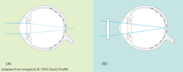 http://www.elu.sgul.ac.uk/rehash/guest/scorm/209/package/content/images/hyperopia.gif